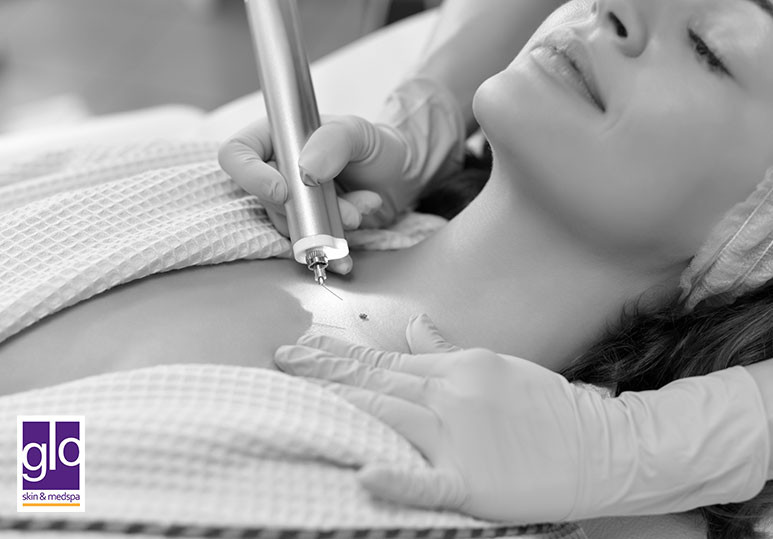 Glo Skin & Medspa | What To Expect Before, During, And After Mole Removal