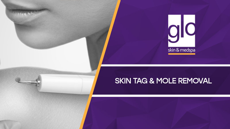 Skin Tag/Mole Removal