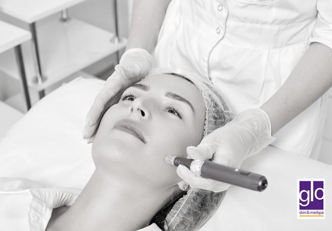 Microneedling 101: Everything You Need to Know About the Skincare Revolution