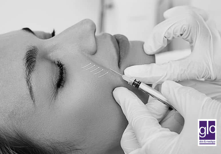 3 Reasons Why Fillers Are the Perfect Solution for Fine Lines