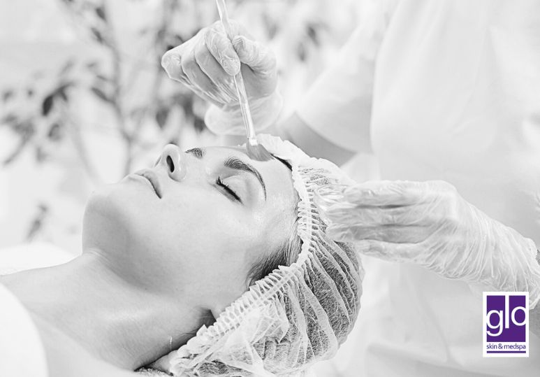 Edmonton Chemical Peels: Top 5 Myths About Chemical Peels Debunked