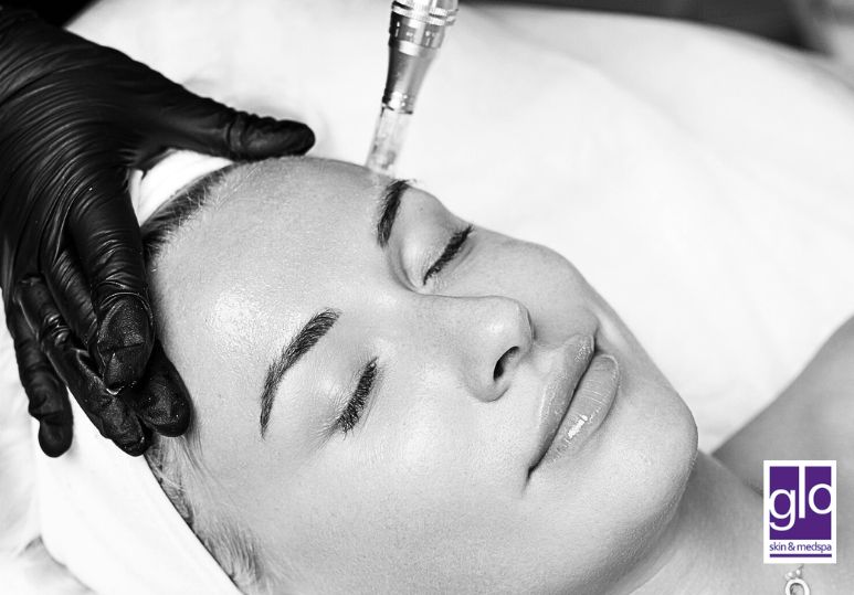 Edmonton Microneedling: Say Goodbye to Fine Lines! How Microneedling Is Transforming Skin