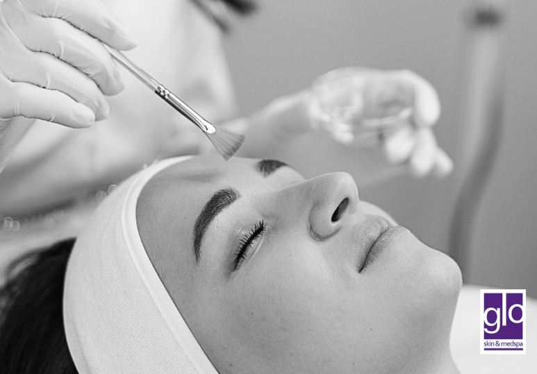 Edmonton Chemical Peels: Why Chemical Peels are Essential for Post-Summer Skin Care