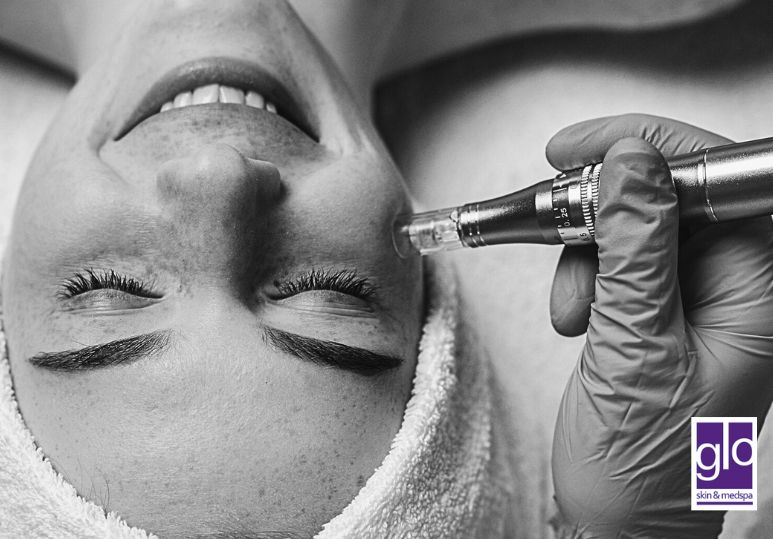 3 Key Benefits of Edmonton Microdermabrasion for Aging Skin