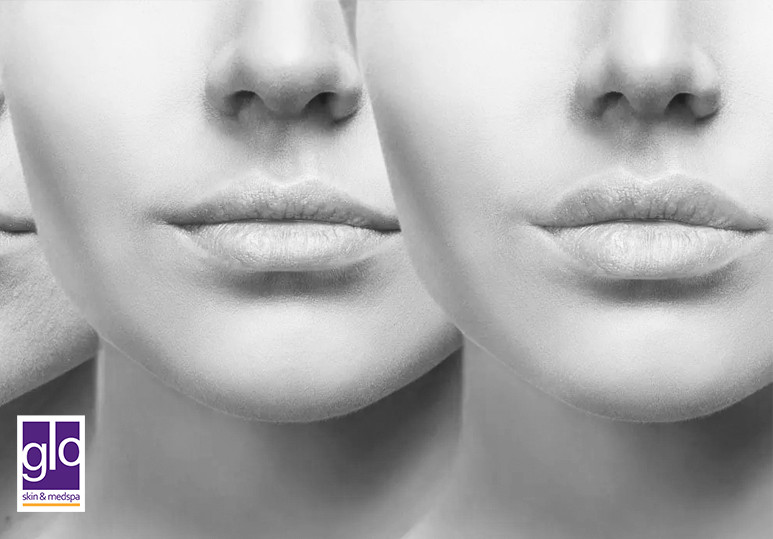 What are JUVÉDERM® fillers?