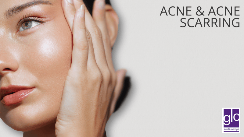 Acne & Acne Scarring