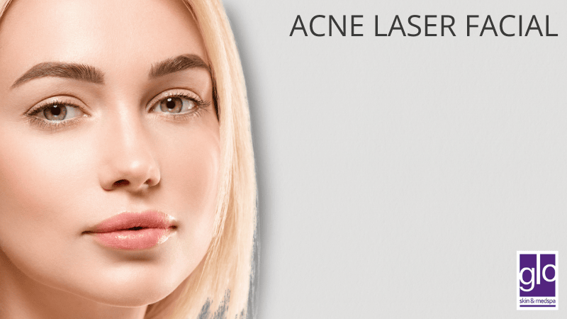 Acne Laser Facial