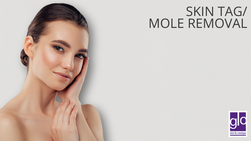 Skin Tag/Mole Removal