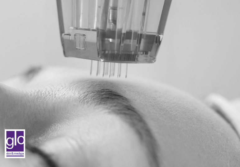 Exosomes + Microneedling: The Power Combo for Winter Skin Renewal