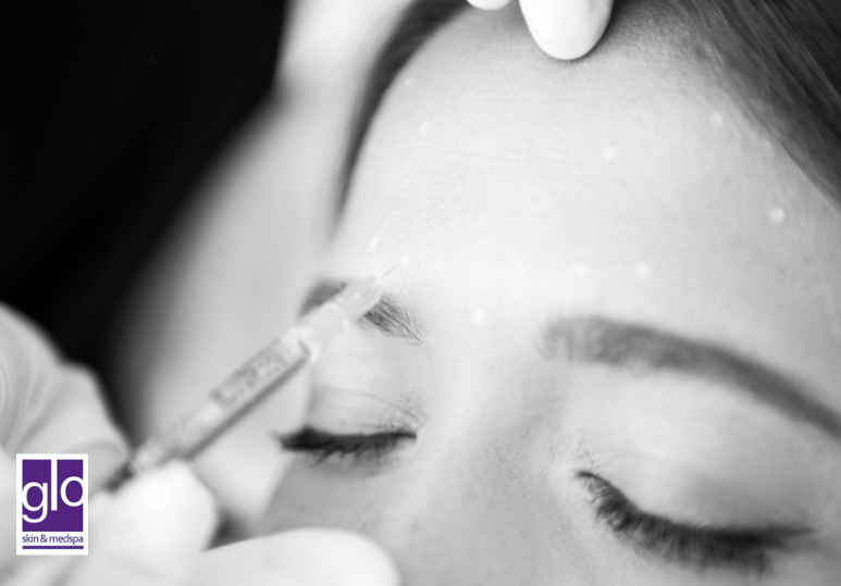 Preventative Botox: Starting Early for Smoother Skin Later 