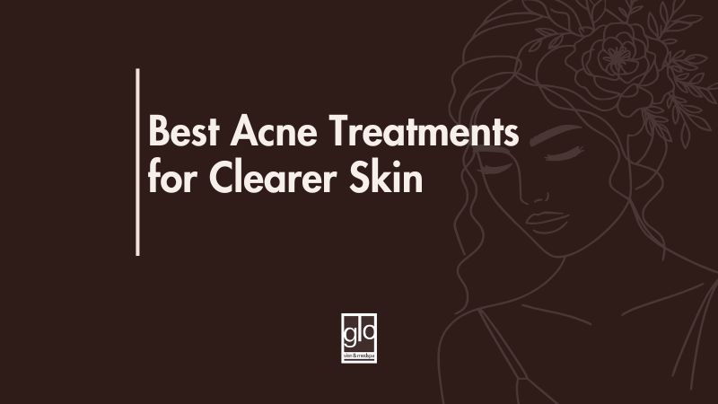 Best Acne Treatments for Clearer Skin - Acne Treatment Edmonton