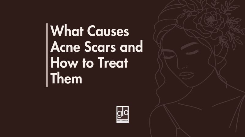 What Causes Acne Scars and How to Treat Them - Acne Scar Treatment Edmonton