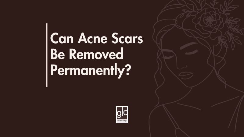 Can Acne Scars Be Removed Permanently? - Acne Scar Treatment Edmonton