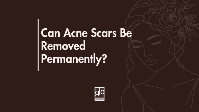 Can Acne Scars Be Removed Permanently?