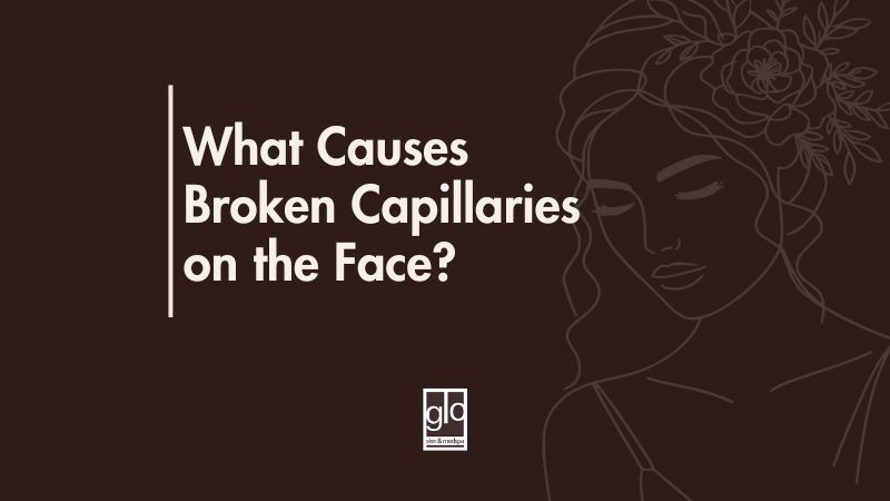 What Causes Broken Capillaries on the Face?